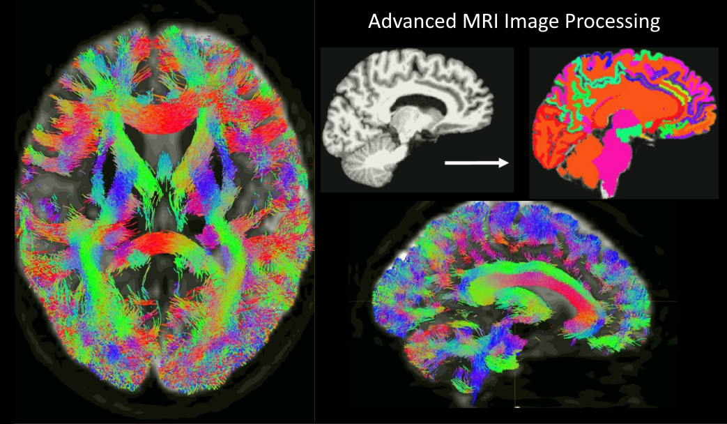 Brain MRI modalities including diffusion MRI and anatomical MRI, used to produce macro-scale connectivity maps called connectomes.